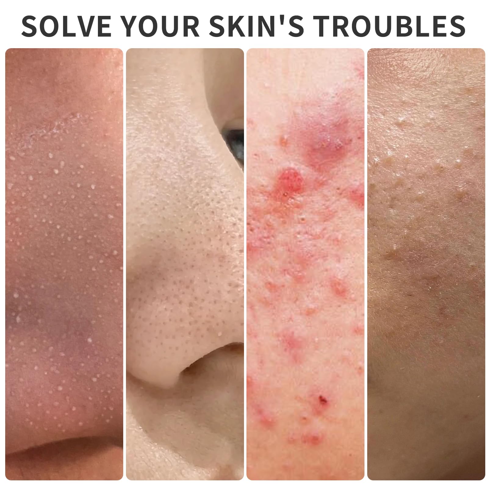 3 Piezas Pinzas de Punta Fina, Eliminación de Pinzas Blackhead Precisión Acero Inoxidable Depilar Punta Fina Profesionales para Espinillas Acné Cejas Pelo Encarnado (con Caja)