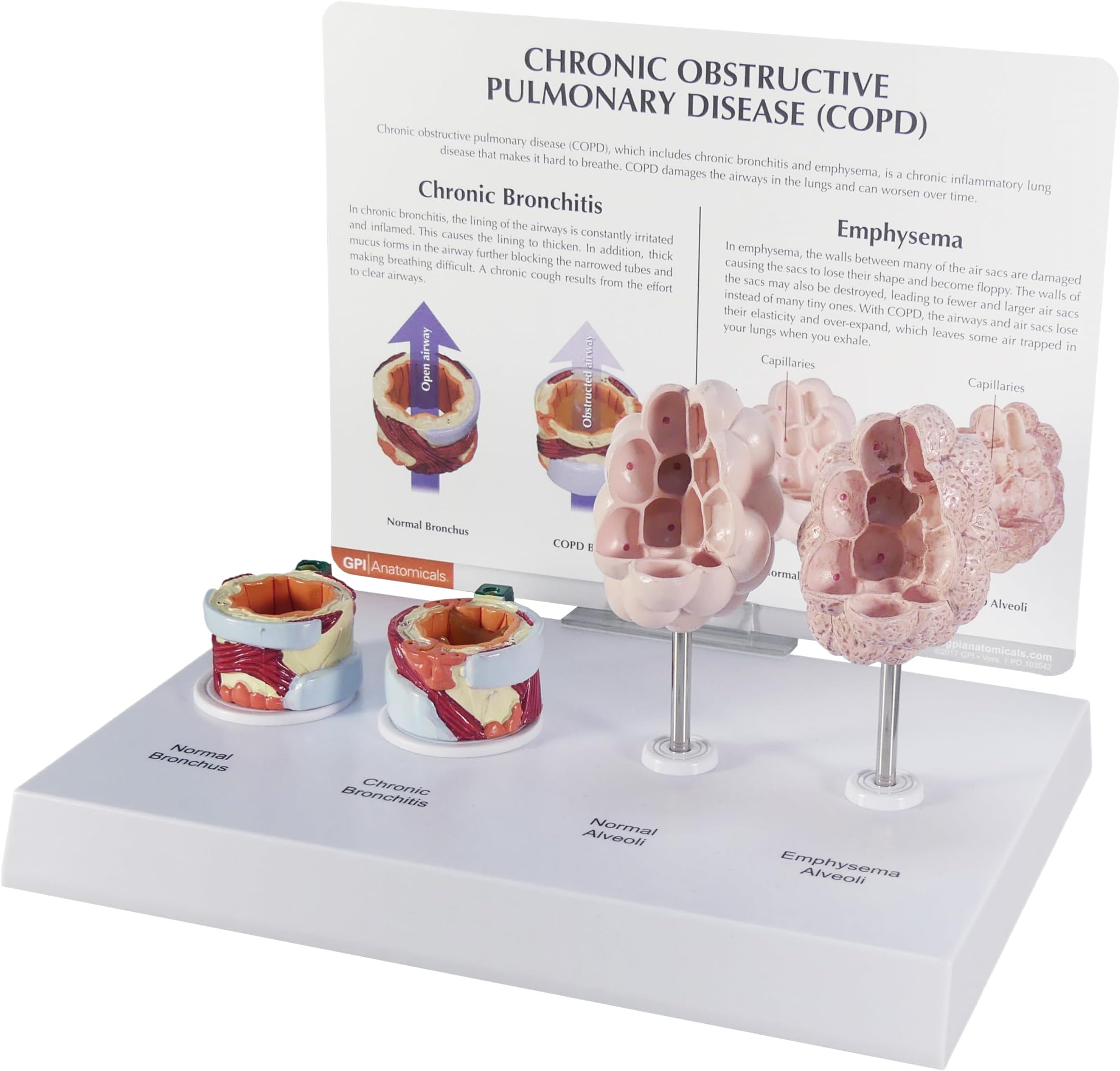 GPI Anatomicals - Anatomy Model of Human Respiratory System with Chronic Obstructive Pulmonary Disease (COPD), Bronchus, Alveoli Models for Anatomy and Physiology Education, Medical Learning Resources