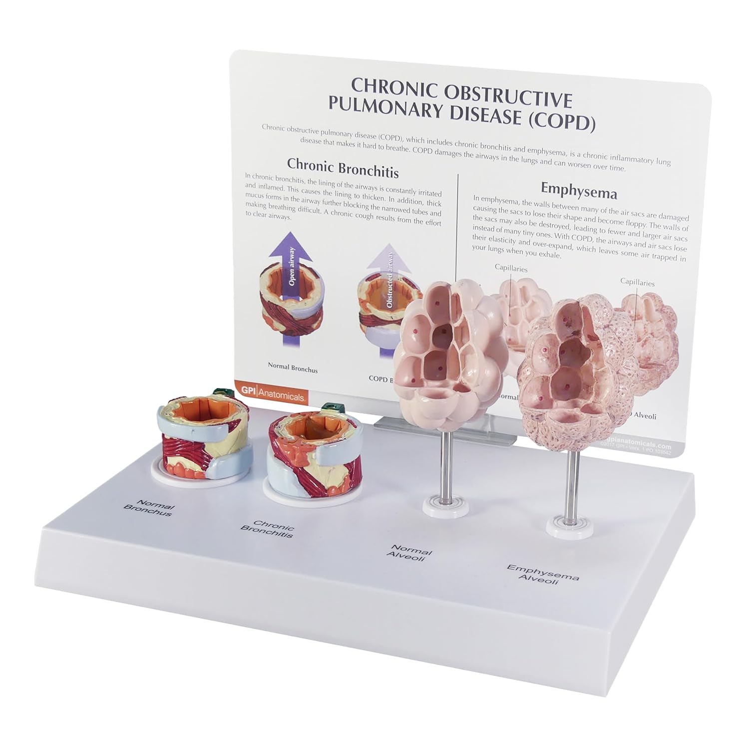 GPI Anatomicals - Anatomy Model of Human Respiratory System with Chronic Obstructive Pulmonary Disease (COPD), Bronchus, Alveoli Models for Anatomy and Physiology Education, Medical Learning Resources