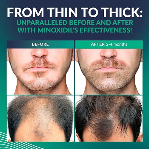 Miniatura 5 de Minoxidil para hombres 5%  Crecimiento del cabello, kit de crecimiento de barba Minoxidil 5 por ciento + vitamina E, ginseng, extracto de jengibre,