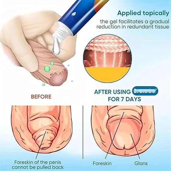 Phimosis Cream for Adults, Phimosis Cream Tight Foreskin, Phimosis Correction Gel, Natural Ingredients Phimosis Foreskin Correction Gel (1)