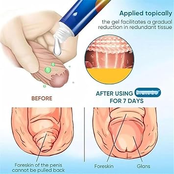 Phimosis Cream for Adults, Phimosis Cream Tight Foreskin, Phimosis Correction Gel, Natural Ingredients Phimosis Foreskin Correction Gel (1)