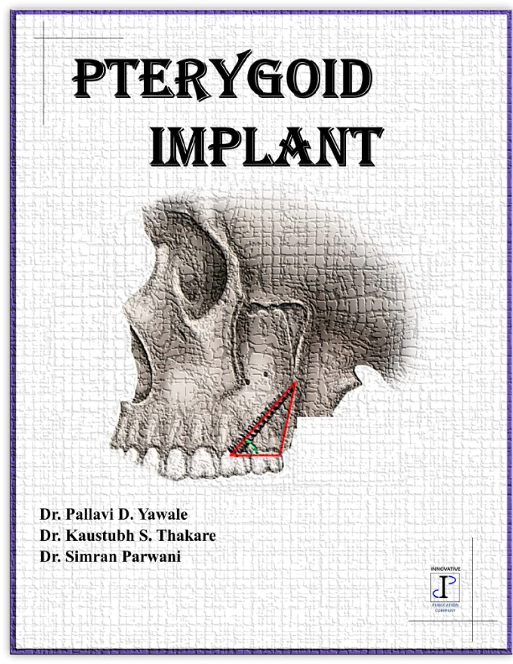 PTERYGOID IMPLANT