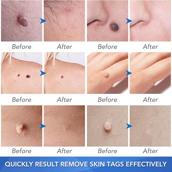 Skin Tag Removal, Effectively and Painless Skin Mole Tag Remover Set-Safe and Easy Remove Small to Large (2mm-8mm) Sized Skin Tags-Tags Fall Off Remover Kit at Home