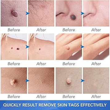Skin Tag Removal, Effectively and Painless Skin Mole Tag Remover Set-Safe and Easy Remove Small to Large (2mm-8mm) Sized Skin Tags-Tags Fall Off Remover Kit at Home