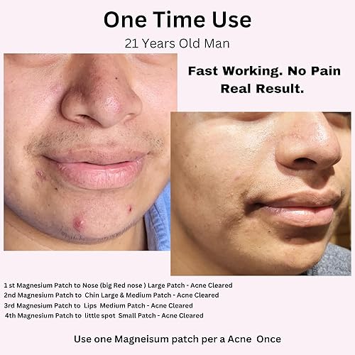 Miniatura 9 de Laflare Micropunto de magnesio para manchas de acné. Zit y manchas oscuras de post-imperfección, acné. Magnesio autodisolvible, hidrocoloide, aceite