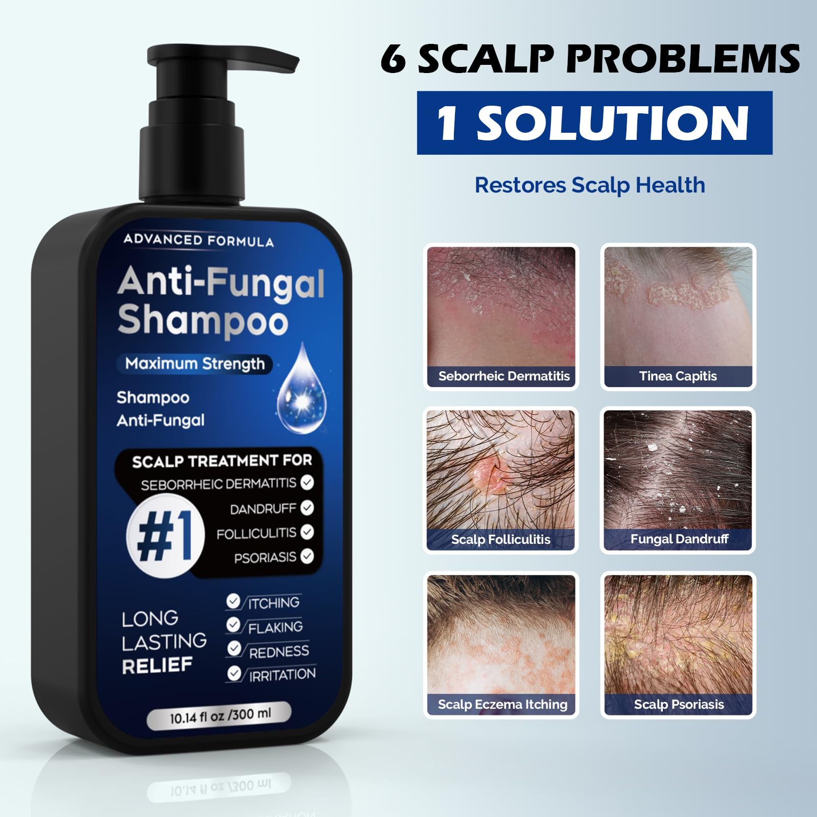 Champú antifúngico para dermatitis seborreica, foliculitis y psoriasis del cuero cabelludo, champú anticaspa para hombres y mujeres, alivia la picazón del cuero cabelludo, la sequedad, sin sulfatos ni 2