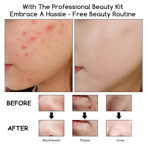 Miniatura 8 de 9 piezas de agujas de acero inoxidable para eliminar espinillas, pinzas de limpieza de acné, kit de herramientas para reventar espinillas con una