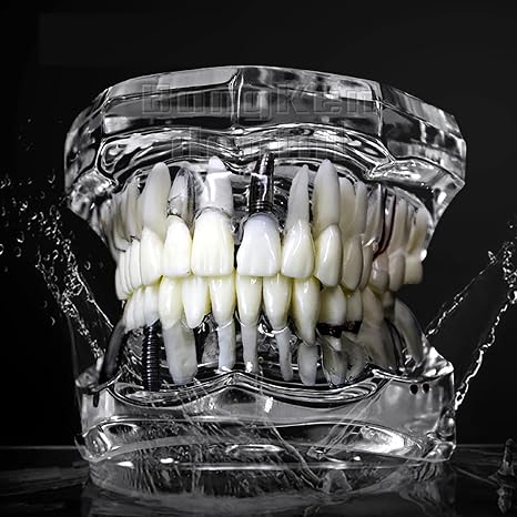 Dental Implant Models Restoration Typodont Teeth Tooth Model Demo Oral Pathology Bridge Teach Study Clear Color M2001