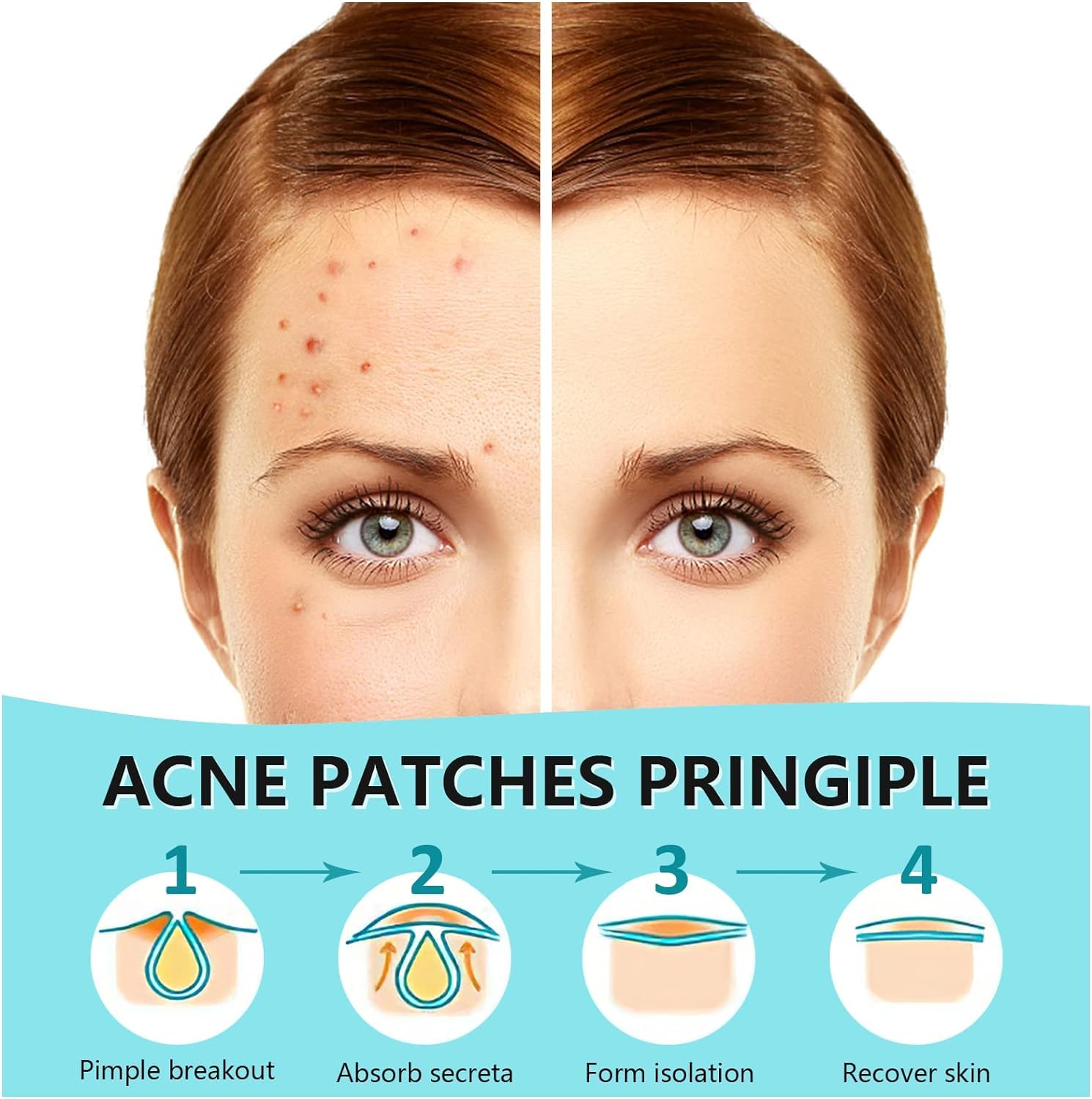 PICcircuit Pimple Patches for Face, Hydrocolloid Acne Patches, Invisible Zit Patches for Face, Acne Spot Treatment Patch Cystic Blemish Patches Zit Stickers for all Skin Colors (360 Counts)