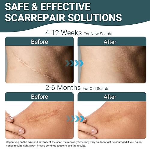 Miniatura 6 de Hojas de silicona para cicatrices para eliminación de cicatrices, cinta reutilizable para cicatrices quirúrgicas, cesáreas, queloides y quemaduras,