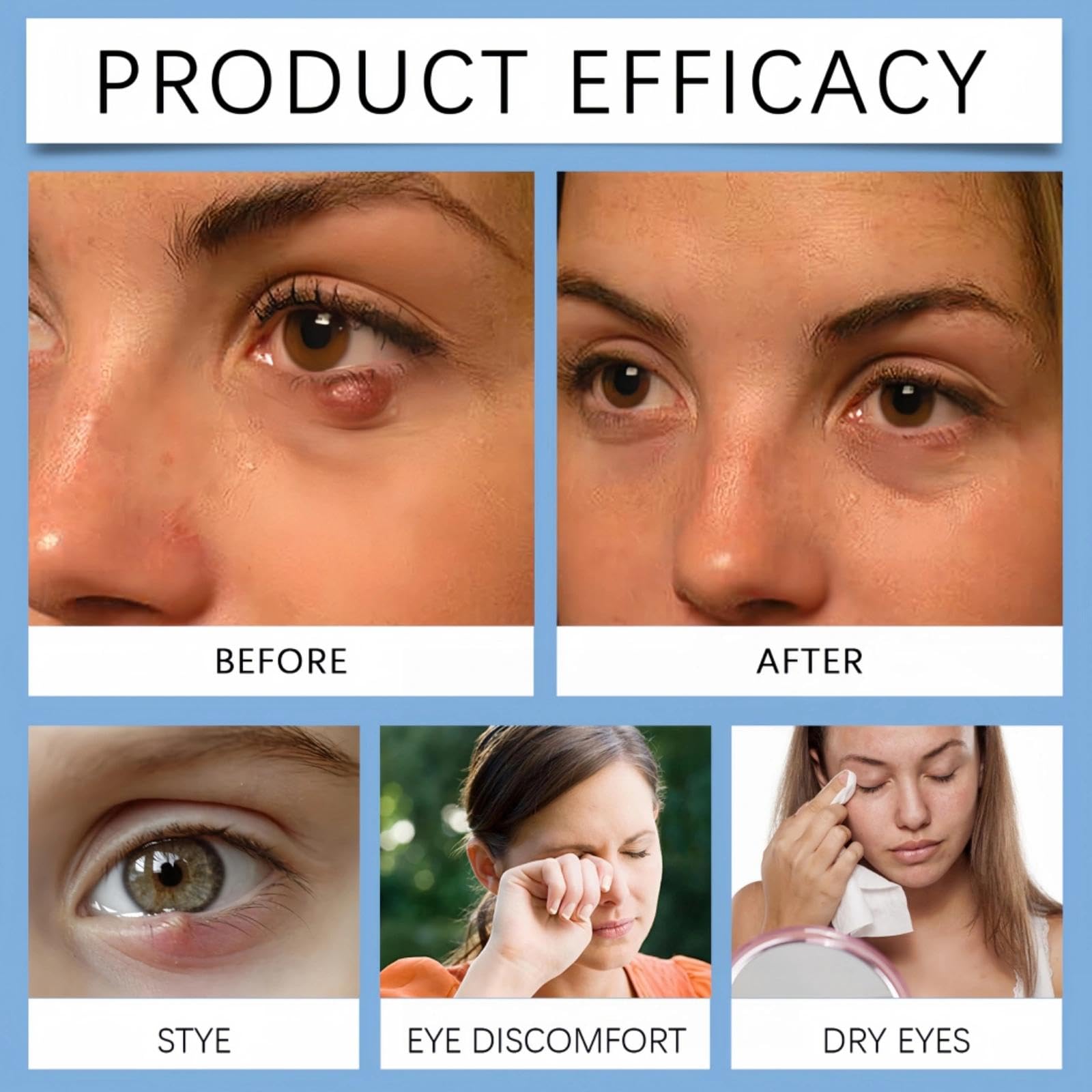 Blepharitis Treatment Eye Cream, Chalazion Eye Treatment, Relief Cream for Eyelids, Soothe Stye, Dry Eyes & Swollen Eyelids - Image 2