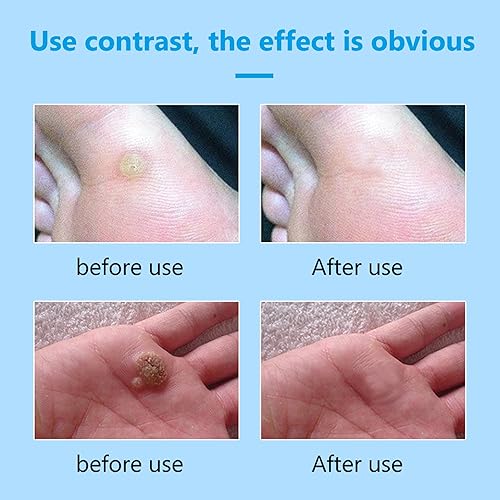 Miniatura 6 de Removedor de verrugas 0.71 oz, crema para eliminar verrugas genitales, removedor de verrugas, adecuado para hombres y mujeres, suave y no irritante,