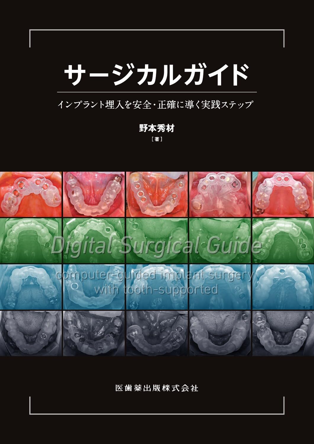 サージカルガイド: インプラント埋入を安全・正確に導く実践ステップ