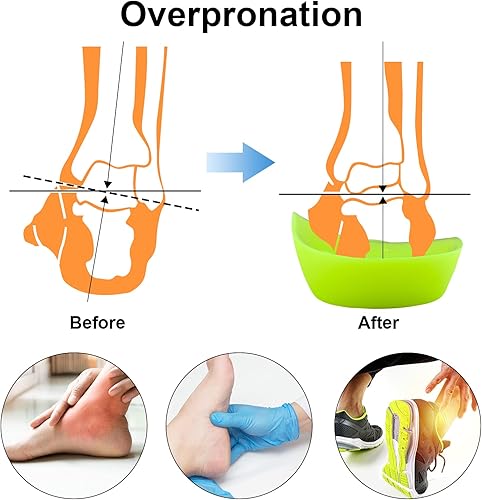 Miniatura 5 de Almohadilla metatarsiana original de arco alto 34 para aliviar la pronación del pie, espalda, cadera, pierna y rodilla, espolones para el dolor para