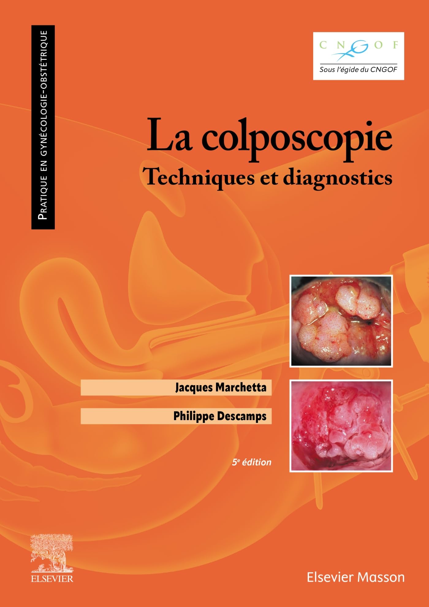La colposcopie: Techniques et diagnostics