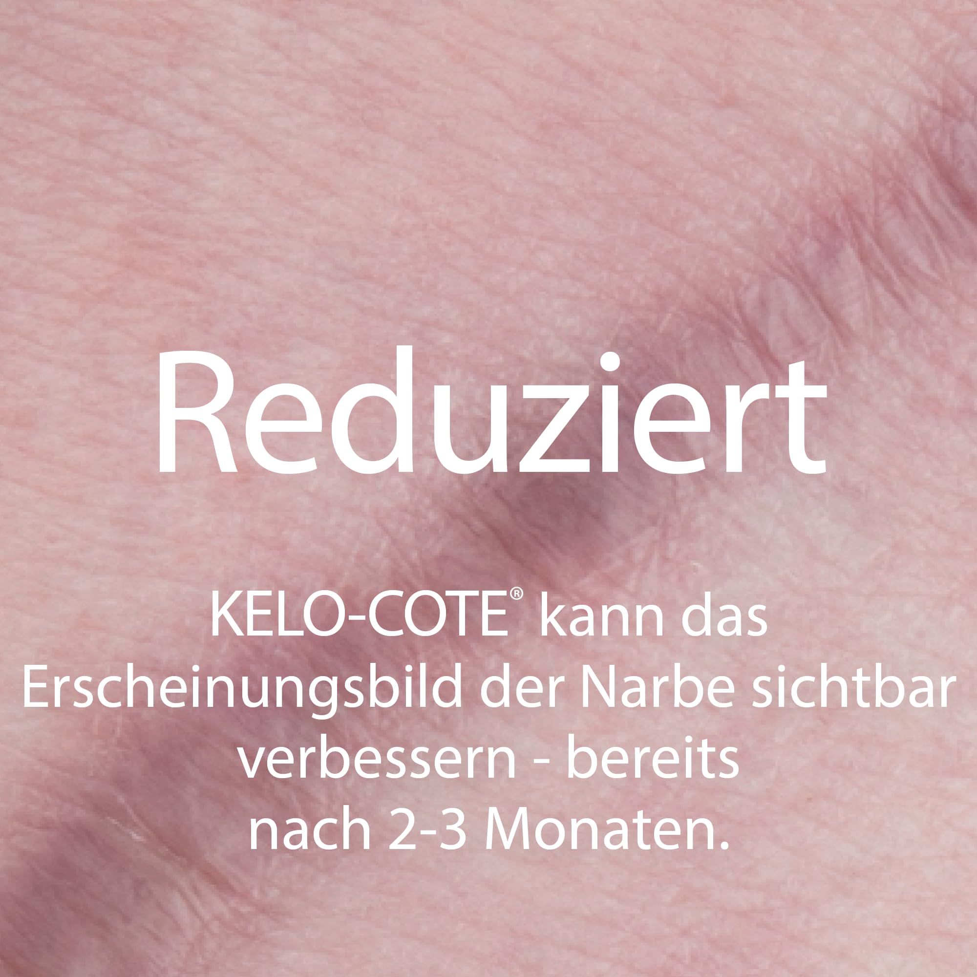 KELO-COTE UV SPF30 Silikon-Narben-Gel 6g mit Sonnenschutz, für chirurgische Narben, erhabene, wulstige Narben wie hypertrophe Narben und Keloide, Verletzungen