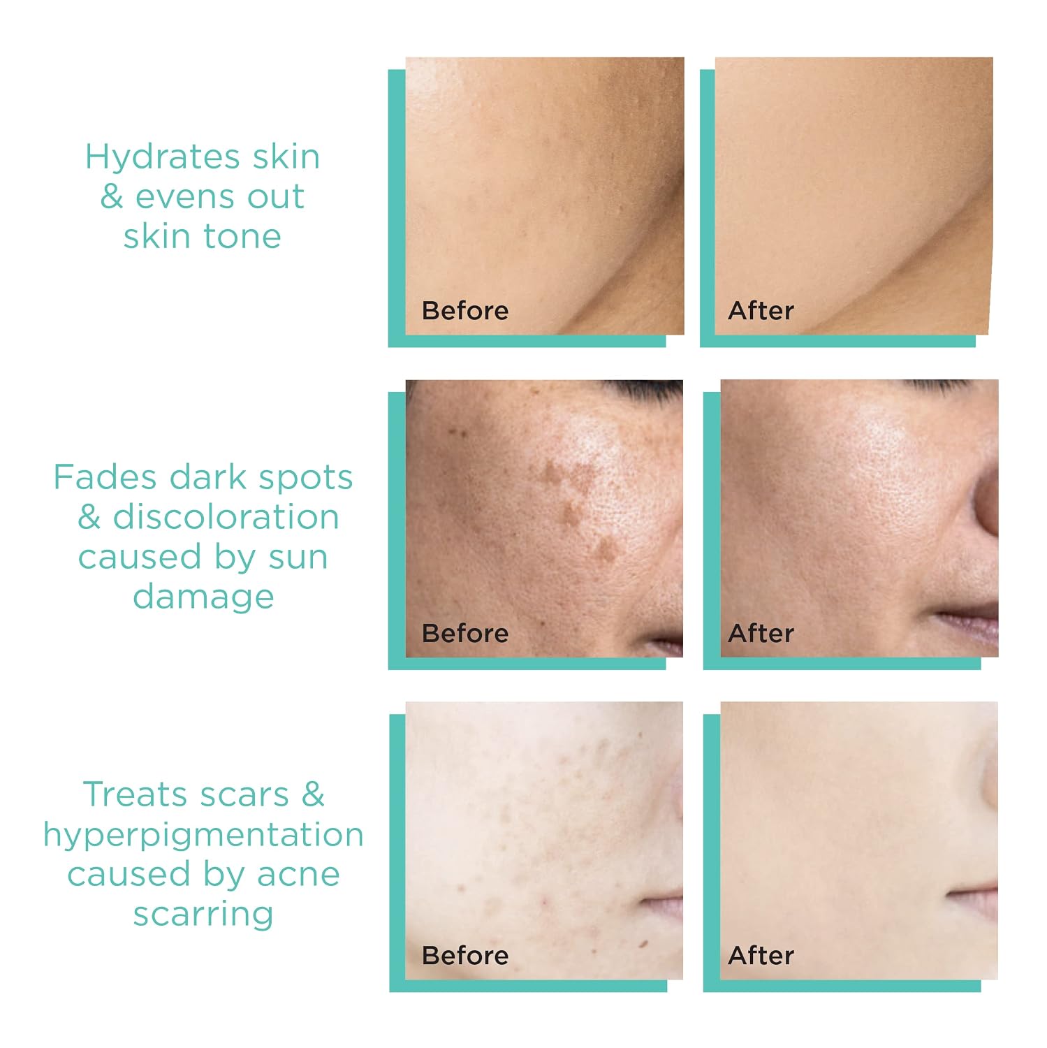 MonétBeauty Kojic Acid Serum for Face and Body, Dark Spot Corrector with Alpha Arbutin, Niacinamide and Squalane, Treats Dark Spots, Discoloration and Acne Scars