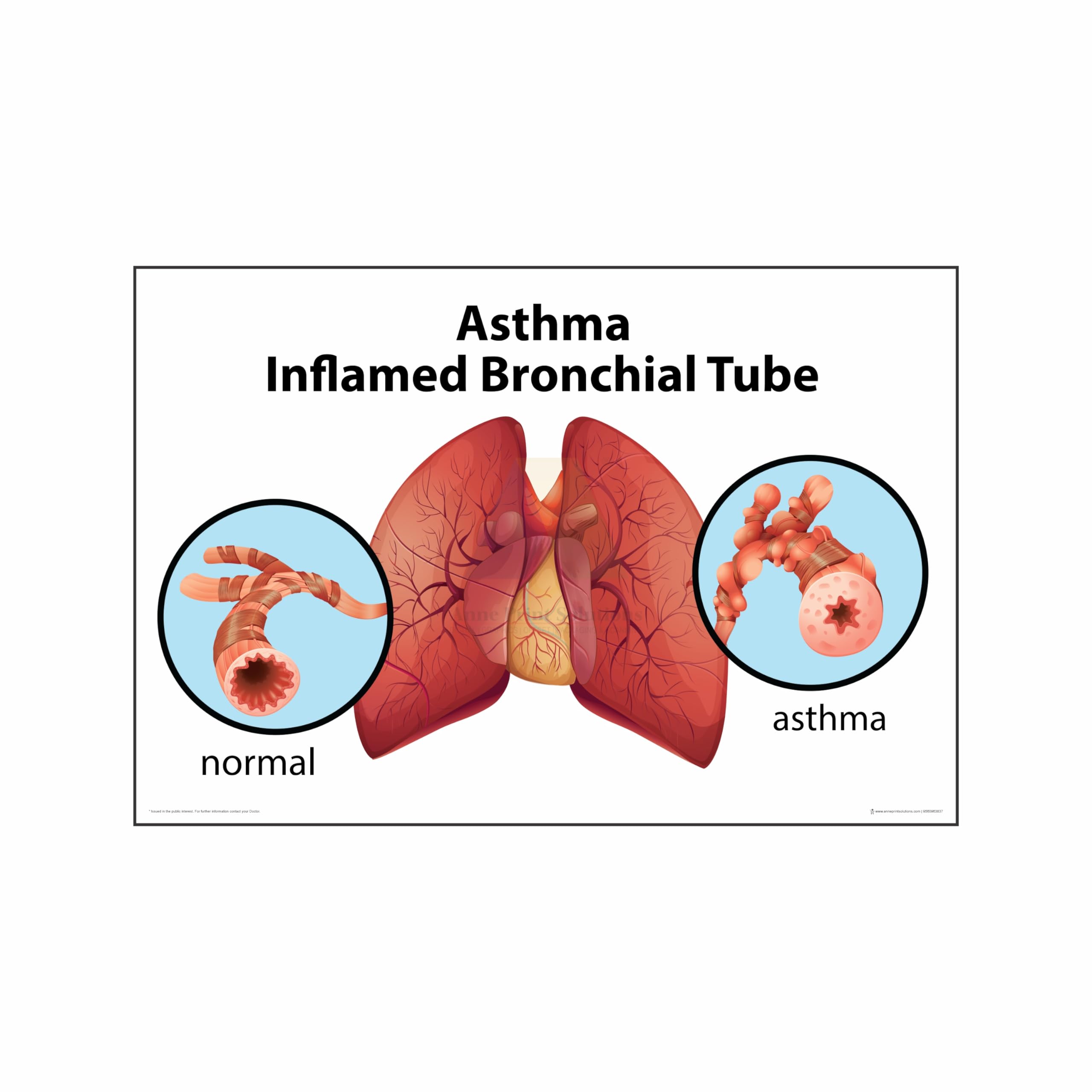 Anne Print Solutions® Asthma Inflamed Bronchial Tube Posters Without Frame Hospital Posters for clinic wall Nursing Home Posters posters for patients wall Pack Of 1 Size 13 X 19 Inch* Multicolour (OPTION 1)