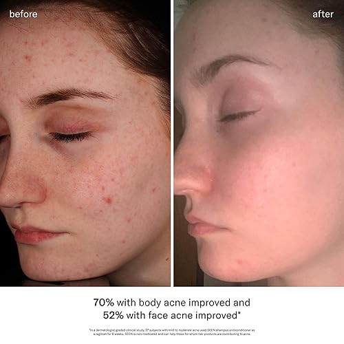 Miniatura 5 de SEEN Paquete seguro para el acné, sin fragancia, champú, acondicionador y parches de espinillas, no comedogénico, sin sulfatos, desarrollado por