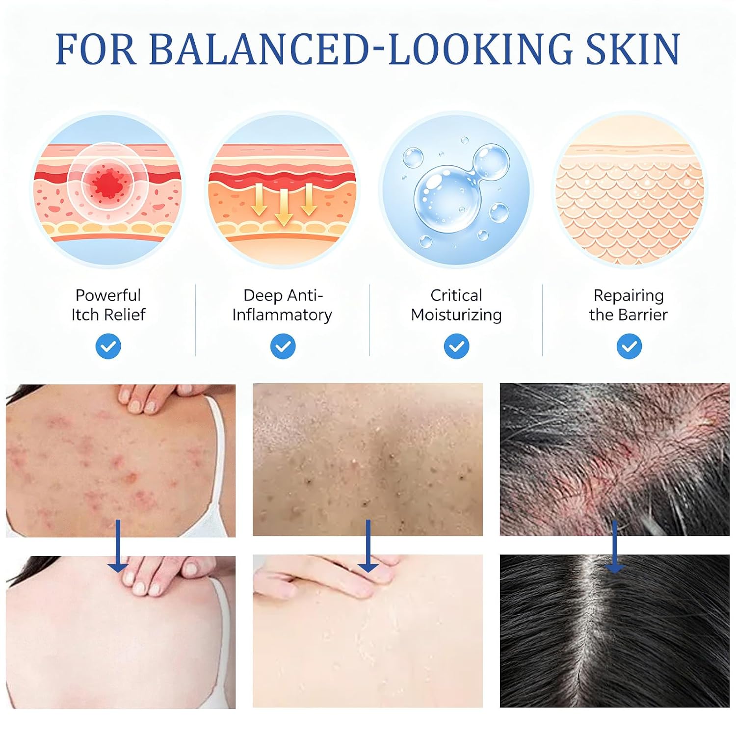 Folliculitis Care Cream for Body & Scalp - Formula for Razor Bumps, Ingrown Hairs & Skin Bumps on Face, Butt, Back - 120g (01)