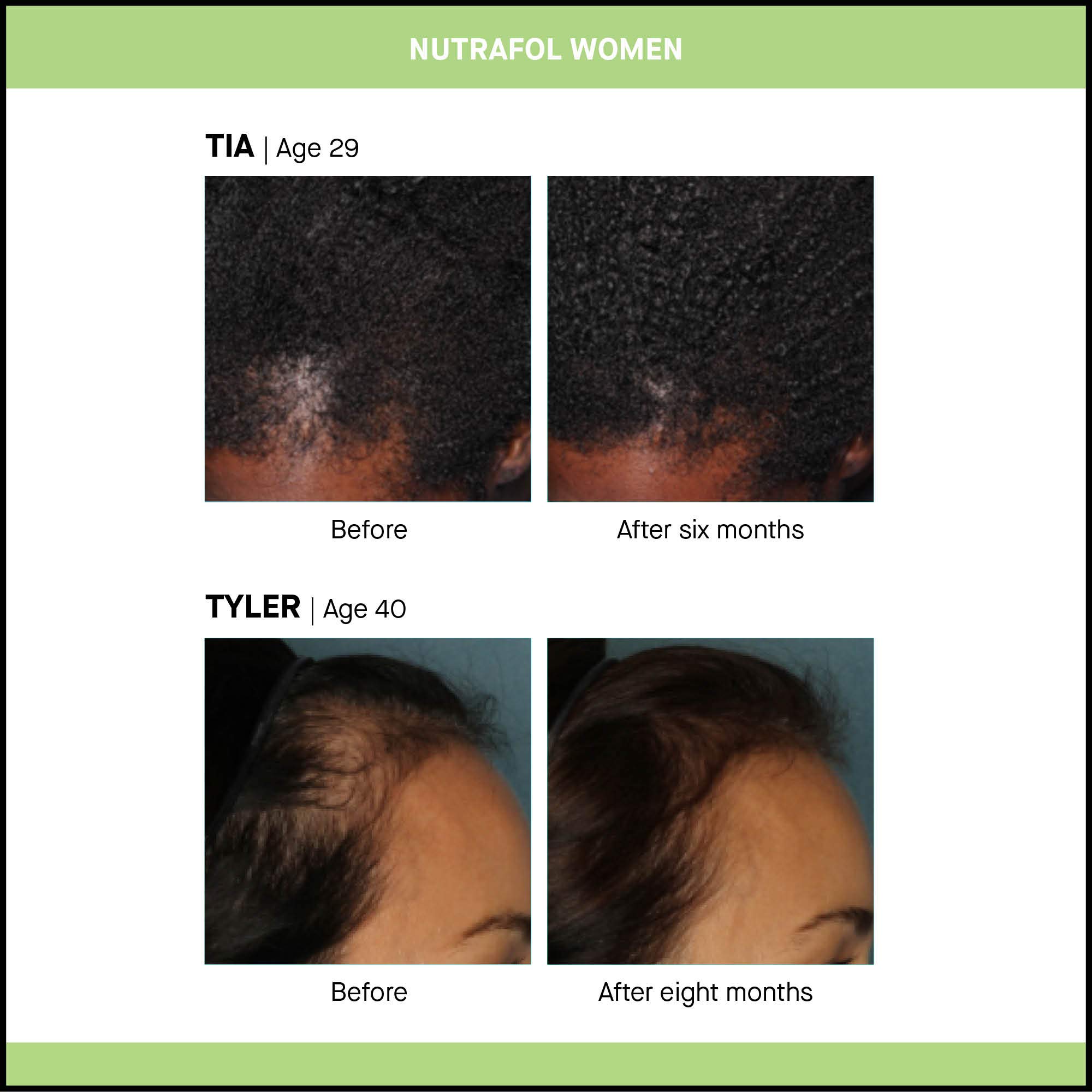 Nutrafol Women Hair Growth Supplement For Thicker