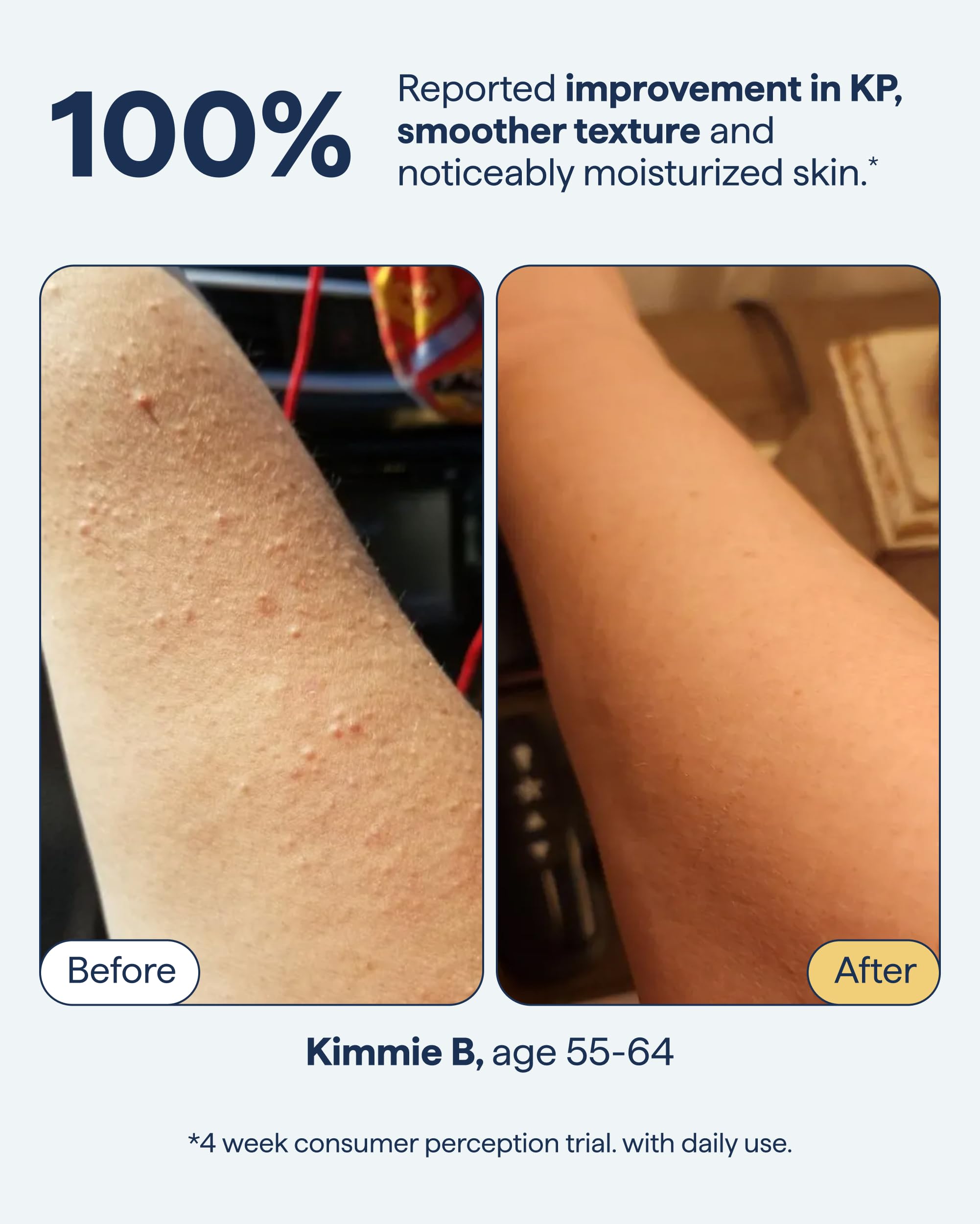can glutathione help keratosis pilaris Amazon.com : Remedy KP Body Moisturizer | Keratosis Pilaris and Chicken Skin Treatment with Retinol, Urea, Lactic Acid and Ceramides | Exfoliating and Moisturizing Lotion