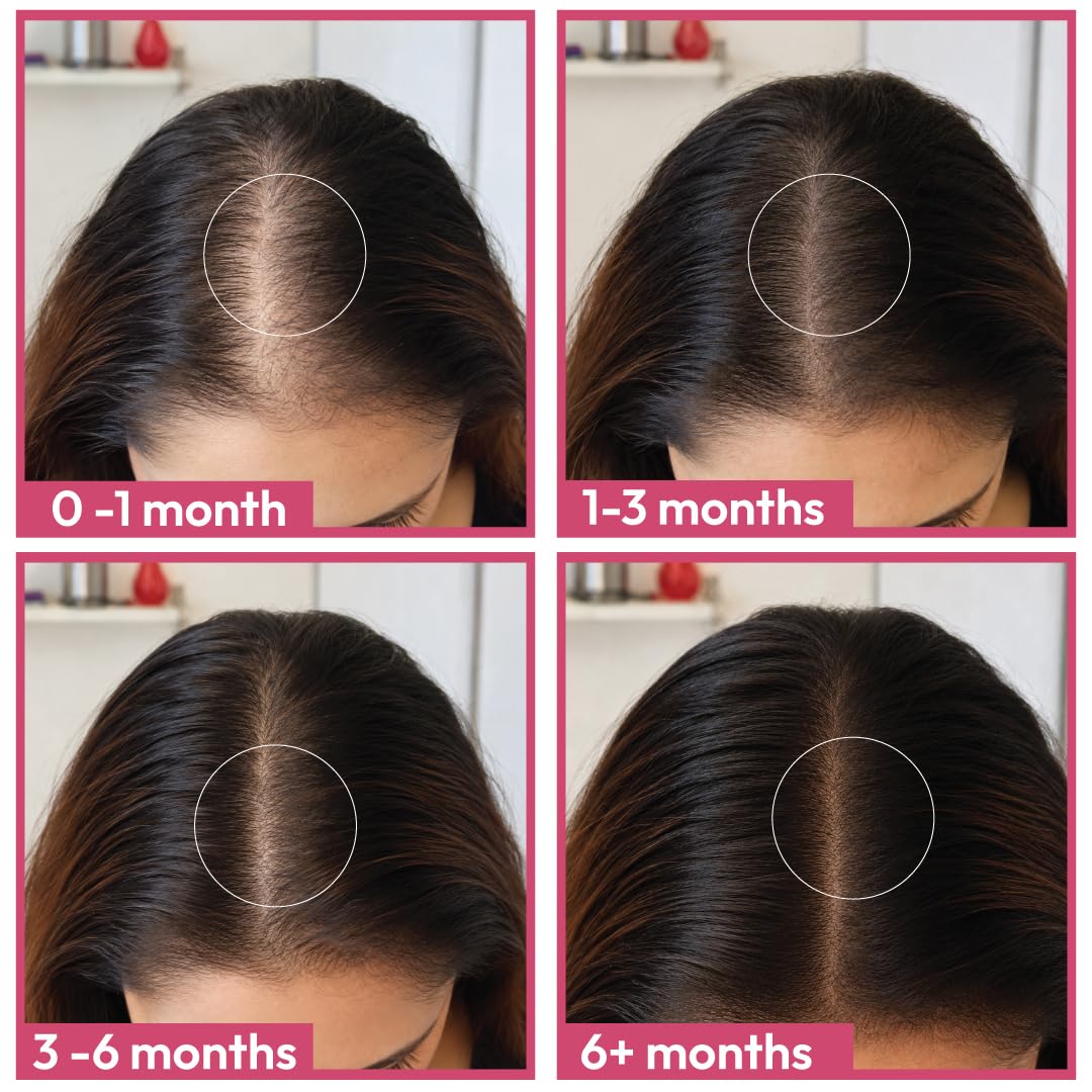 Hair Growth Supplement for Women | Biotin, DHT Blockers & Hair Vitamins | Reduces Hair Fall & Supports Thicker, Stronger Hair | Dermatologist-Formulated, Drug-Free Cyclical Therapy | 1 Month Pack (24 Tablets) — Amazon image 3