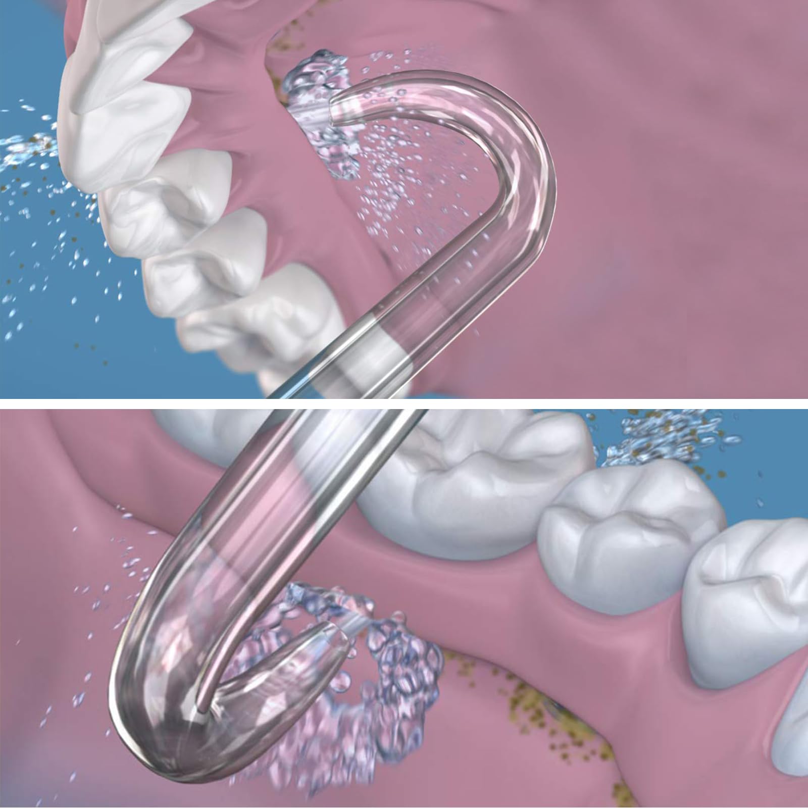 Professional Replacement Tips for Waterpik Water Flosser - 6 Implant Denture Tips - Image 3