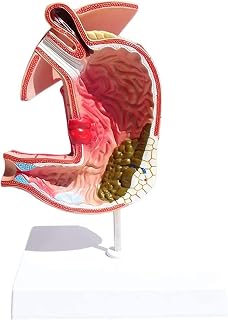 Medical Models, Educational Model Stomach Anatomy Model Gastritis Model Gastric Lesion Model Gastric Diseases Demonstration Human Digestive System Teaching Anatomical Model,Medical Models