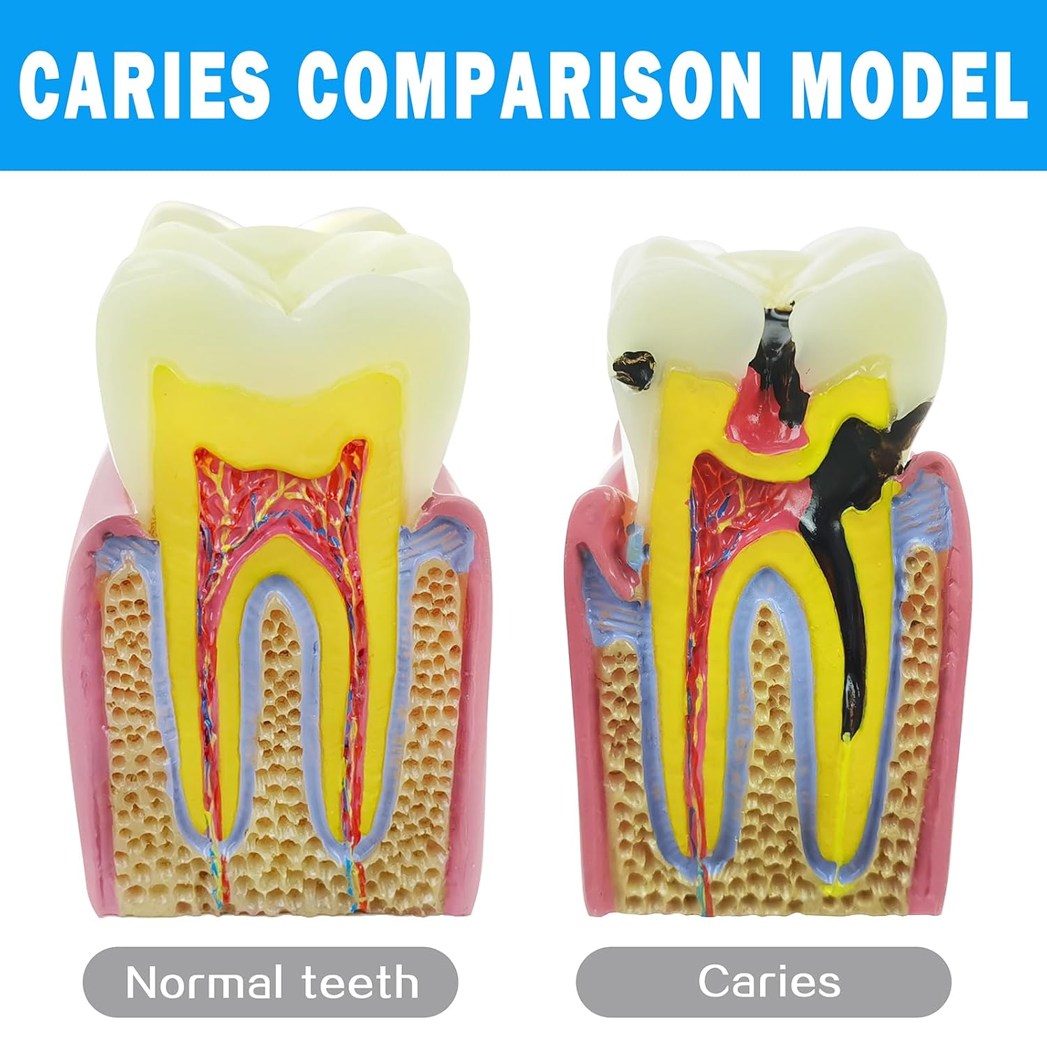 Teeth Model,Tooth Caries Development Model, Dental Anatomy Research and Oral Care Teaching for Doctors and Patients, The Whole Process of Dental Evolution