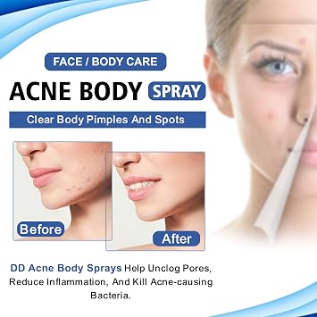 Acne Body for Face & Body – Clear Skin Treatment, Reduces Acne Breakouts, Soothes Irritation – Fast Absorbing & Non-Greasy Formula – Men & Women (50ml)