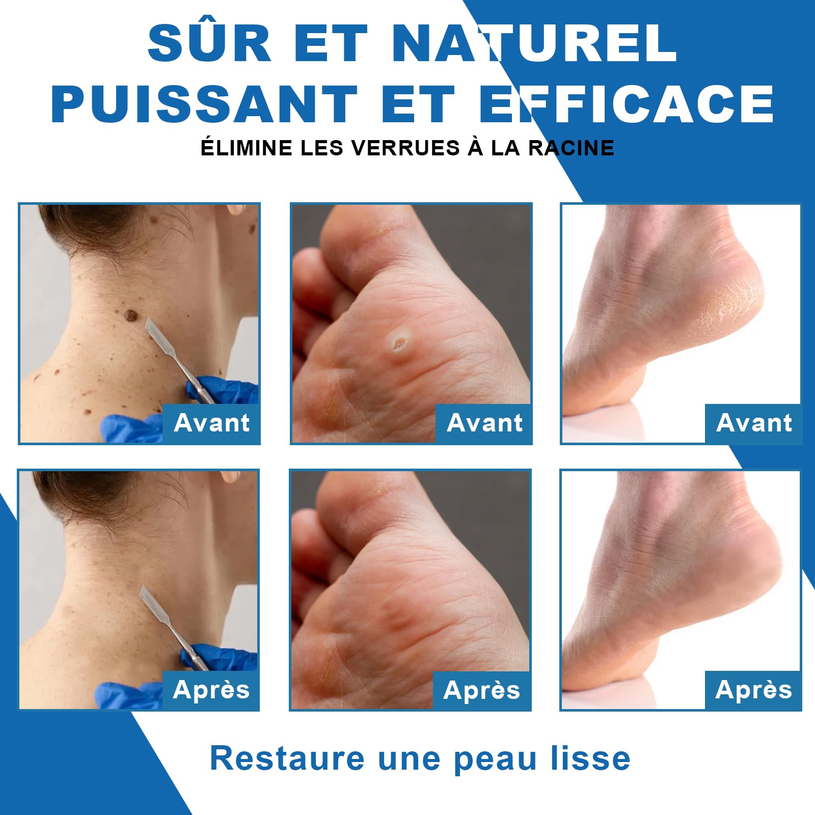 Gel anti-verrues 20g pour le Corps et les Mains