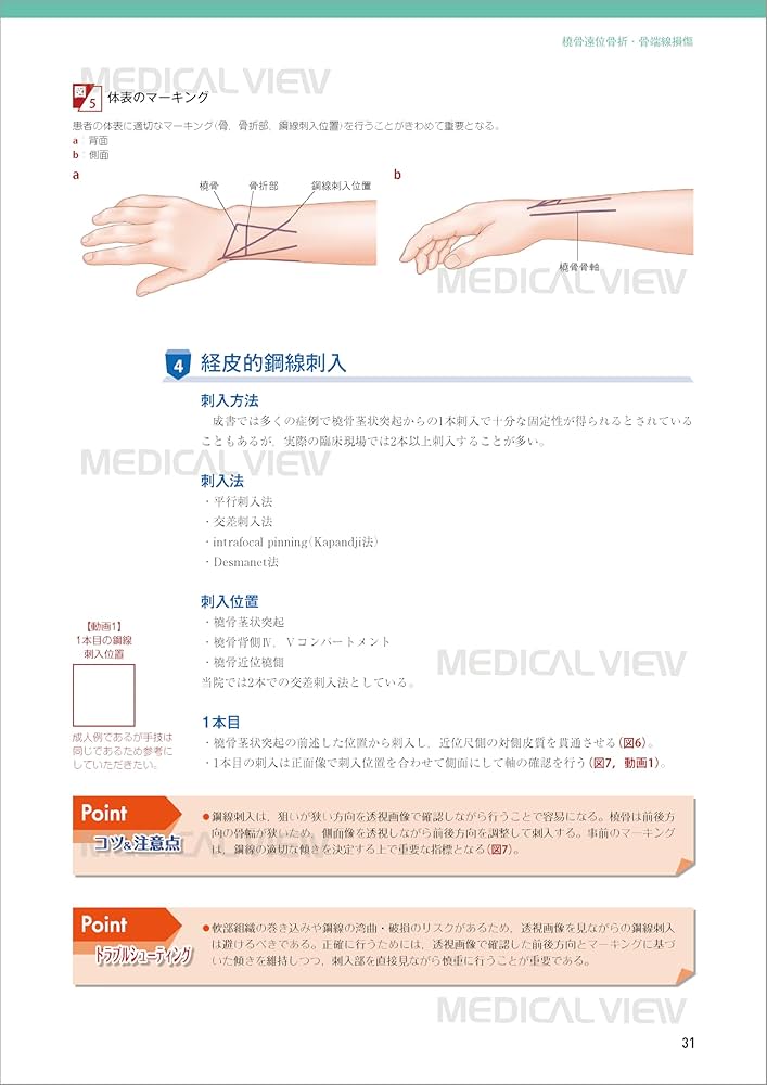 新OS NEXUS No.15 小児の骨折と手術 メジカルビュー社｜整形外科｜新OS NEXUS No.15 小児の骨折と