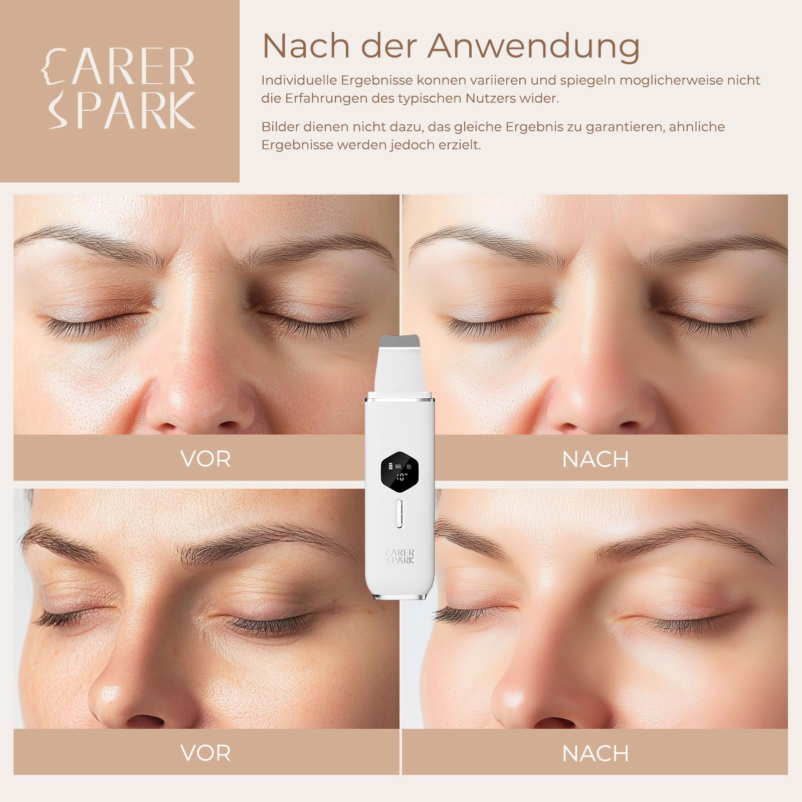 CARER SPARK Skin Scrubber Ultraschall,Ultraschallpeelinggerät für das Gesicht-Mitesser-Entferner mit 4 Modi LED-Anzeige,10-Min-Autoabschaltung für Tiefenreinigung Mitesserentfernung USB-Aufladung