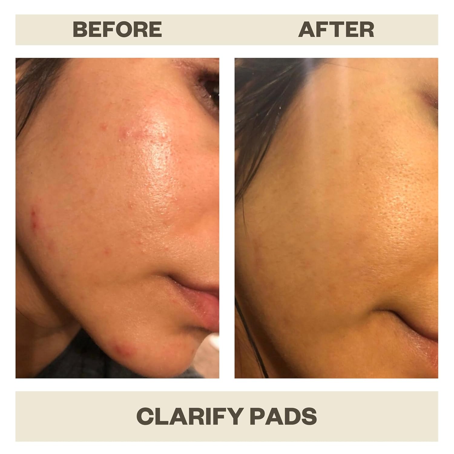 AziMD Skincare Clarify Pads for Face and Body Acne with 2% Salicylic and 2% Glycolic Acid
