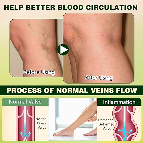 Miniatura 5 de FluidEase - Crema para el edema de piernas, bálsamo para piernas hinchadas, crema de terapia de piernas Fluid Ease para aliviar el edema de piernas