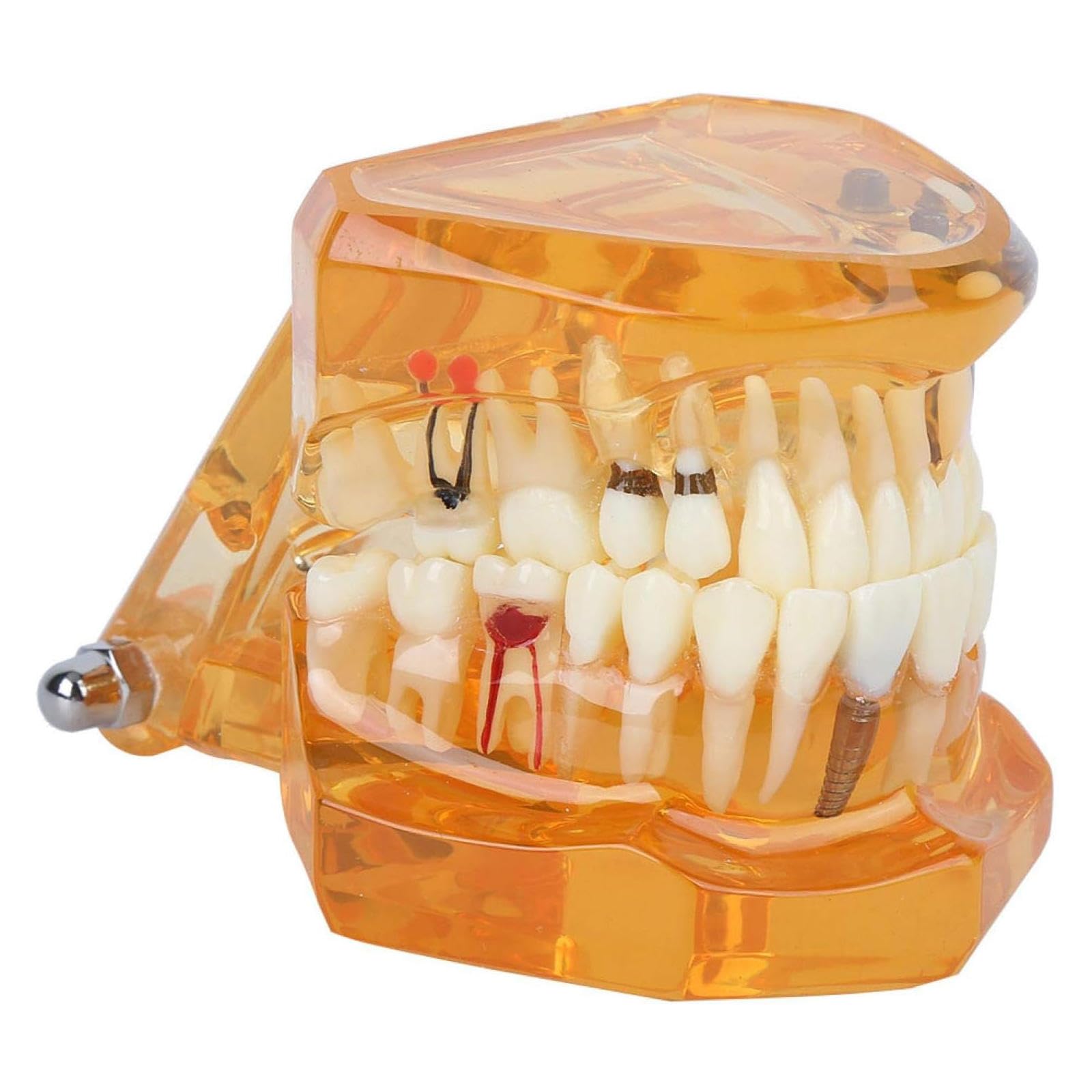 Modello di Insegnamento dello Studio Rimovibile di Malattie Dentali, Modello per Programmi Scolastici di Odontoiatria, Modello di Impianto Dentale, Strumento Dimostrativo