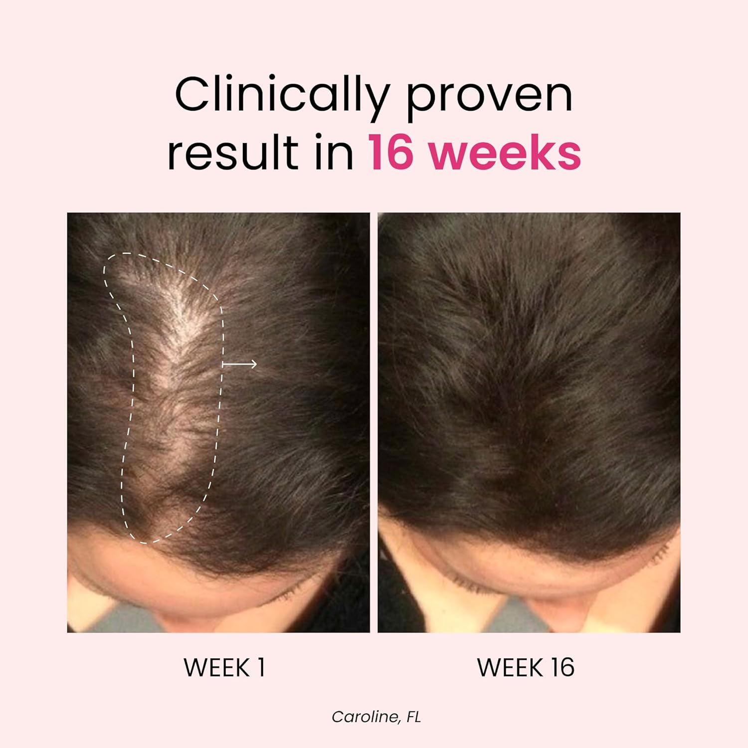 Trybello Hair Growth & Anti-Stress Gummies for Women | Powered by AnaGain — Plant-Based Biotin | Sugar-Free, Vegan Hair Supplements | Gluten-Free Gummy Vitamins for Thicker Healthier Hair | 60 Gummies - Image 3