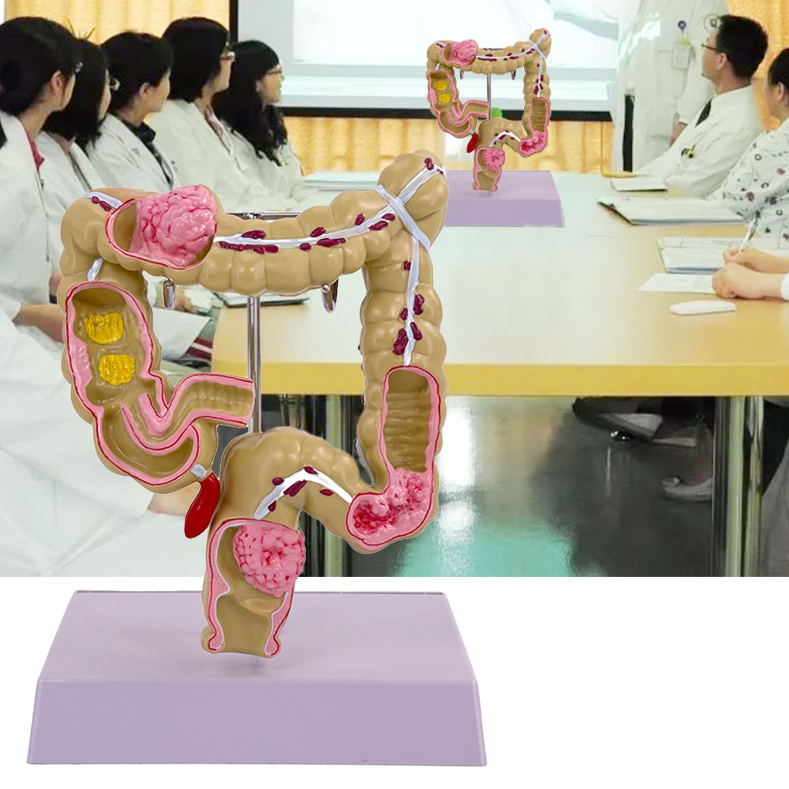 Modello umano dell'intestino crasso Patologie umane del modello dell'intestino crasso Strumento didattico per studi scolastici di laboratorio Patologie del modello dell'intestino crasso Modello di
