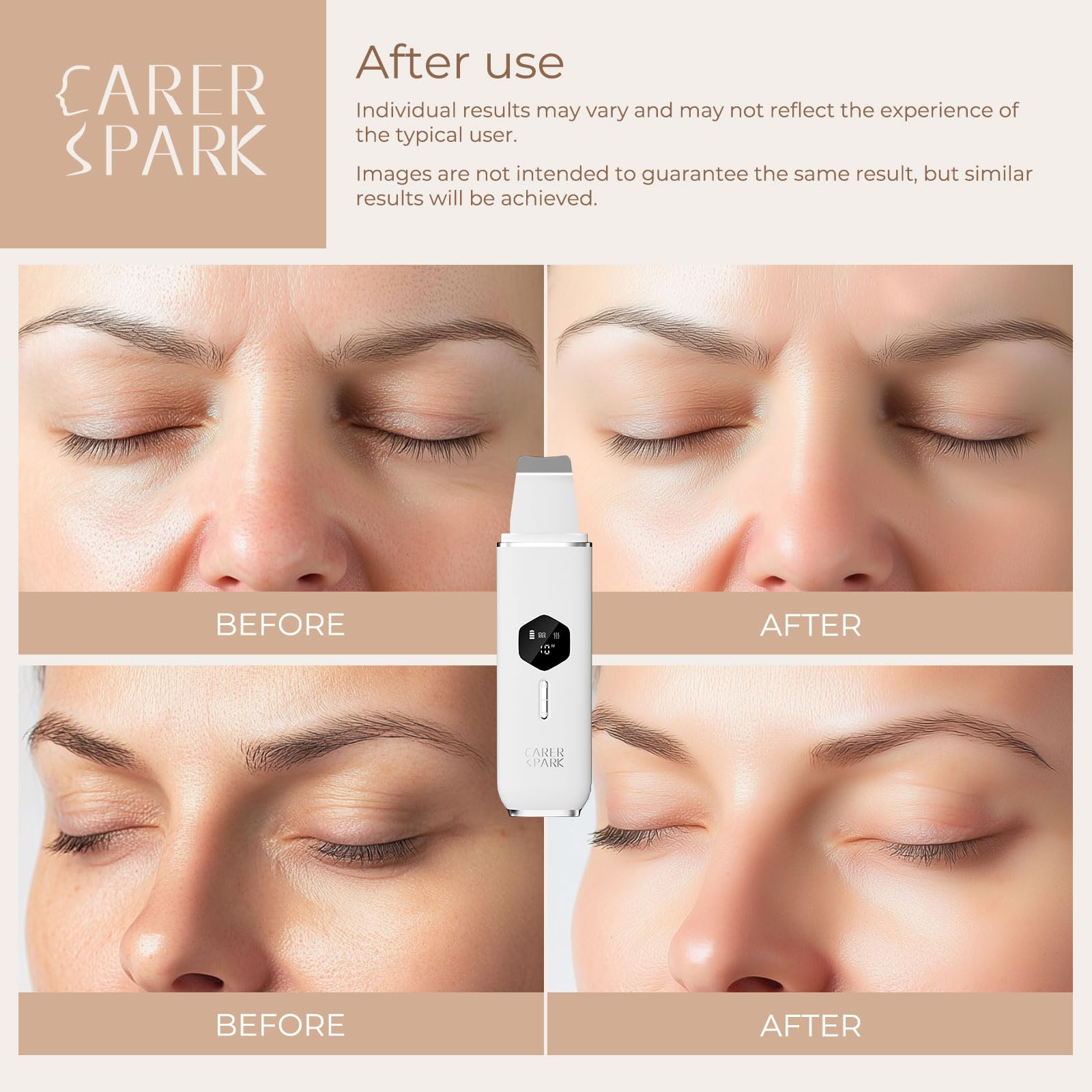 CARER SPARK Pulizia Viso Ultrasuoni,Peeling Ultrasonico Facial Skin Scrubber 4 Modalità Regolabili USB Ricaricabile Schermo LED Pulizia Profonda Rimozione Comedoni Esfoliazione Delicata