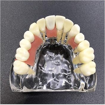 Maxillary Implant Study Analysis Demonstration Teeth Model - Dental Implant Model - with Removable Teeth and Soft Gum