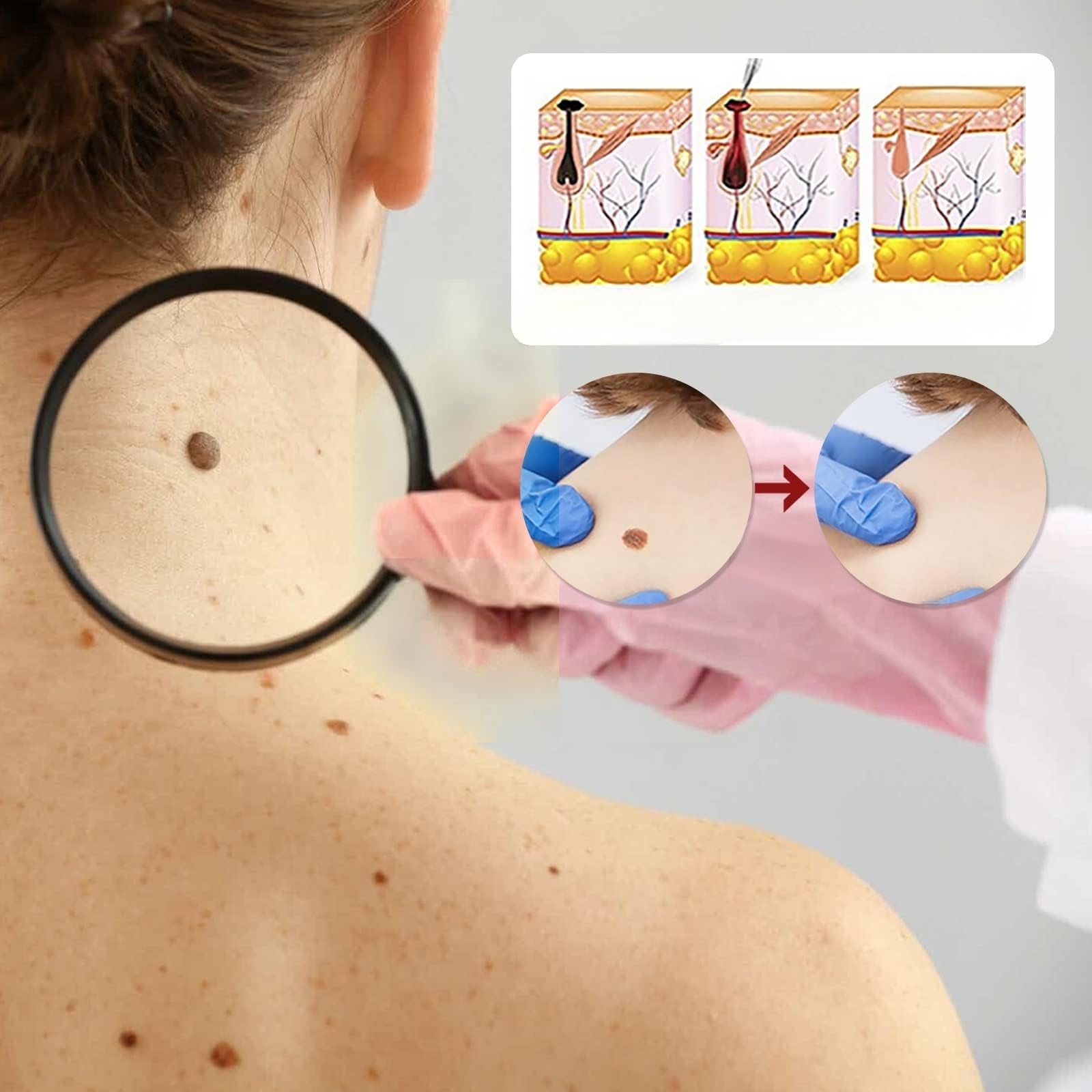 Acción para eliminar acrocordones – Pipeta de precisión para rostro y cuerpo | Eliminación específica de verrugas plantares, vulgares y planas | Fórmula suave con, Sin Dolor | Formato de viaje (10 ml)