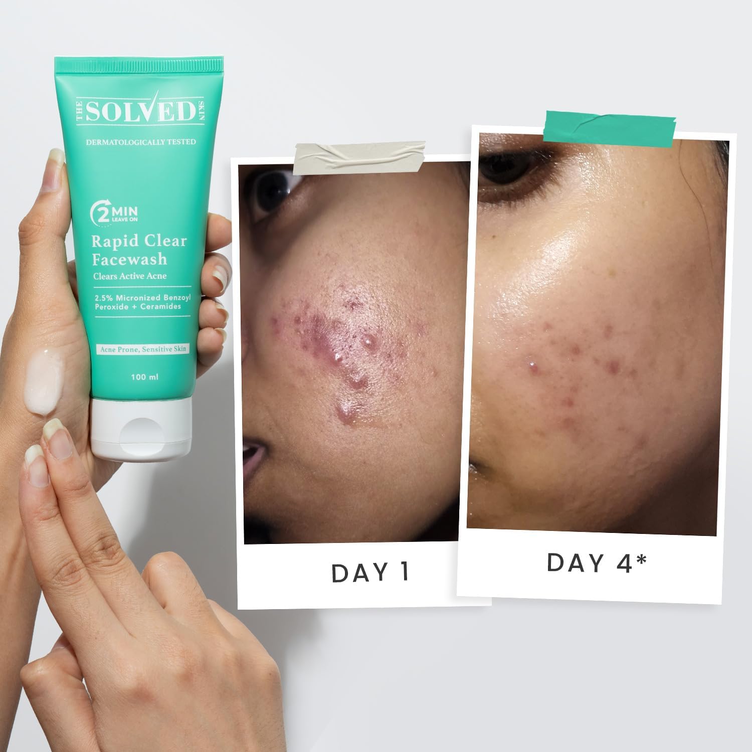 The Solved Skin Rapid Clear Facewash | 2.5% Micronized Benzoyl Peroxide with Ceramides | Dermatologically Tested Cleanser for Acne-Prone, Sensitive & Oily Skin - 100 ml