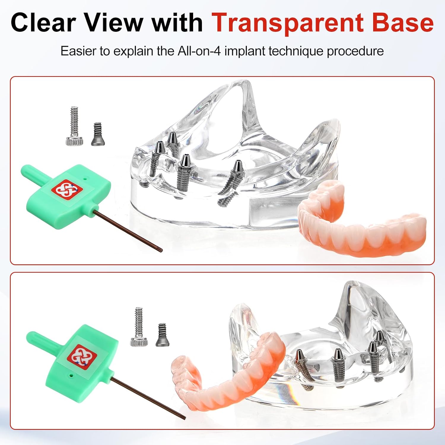 PER4MANCE All-on-4 Dental Implant Model: Includes Upper and Lower Jaw with Transparent Base, Removable Crowns for Educational Demonstration