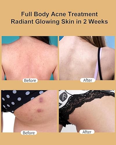 Miniatura 4 de Tratamiento para eliminar el acné de los glúteos, crema hidratante con ácido salicílico al 2%, aceite de árbol de té y hamamelis, tratamiento de