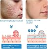 Micro Infusion System for Lips Micro System for Facial Facial Treatment with Serum PockmarksHeal Microneedle Roller with Hyaluronic Acid Serum for Smooth Skin Set of 3