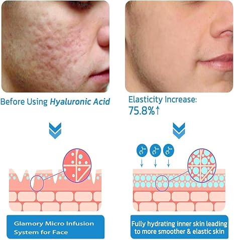 Micro Infusion System for Lips Micro System for Facial Facial Treatment with Serum PockmarksHeal Microneedle Roller with Hyaluronic Acid Serum for Smooth Skin Set of 3