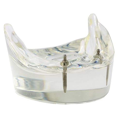 Miniatura 8 de Dientes de implante dental modelo M6002 Typodont Sobredentadura 2 Implantes inferior inferior restauración demostración para estudio enseñar (M6002)