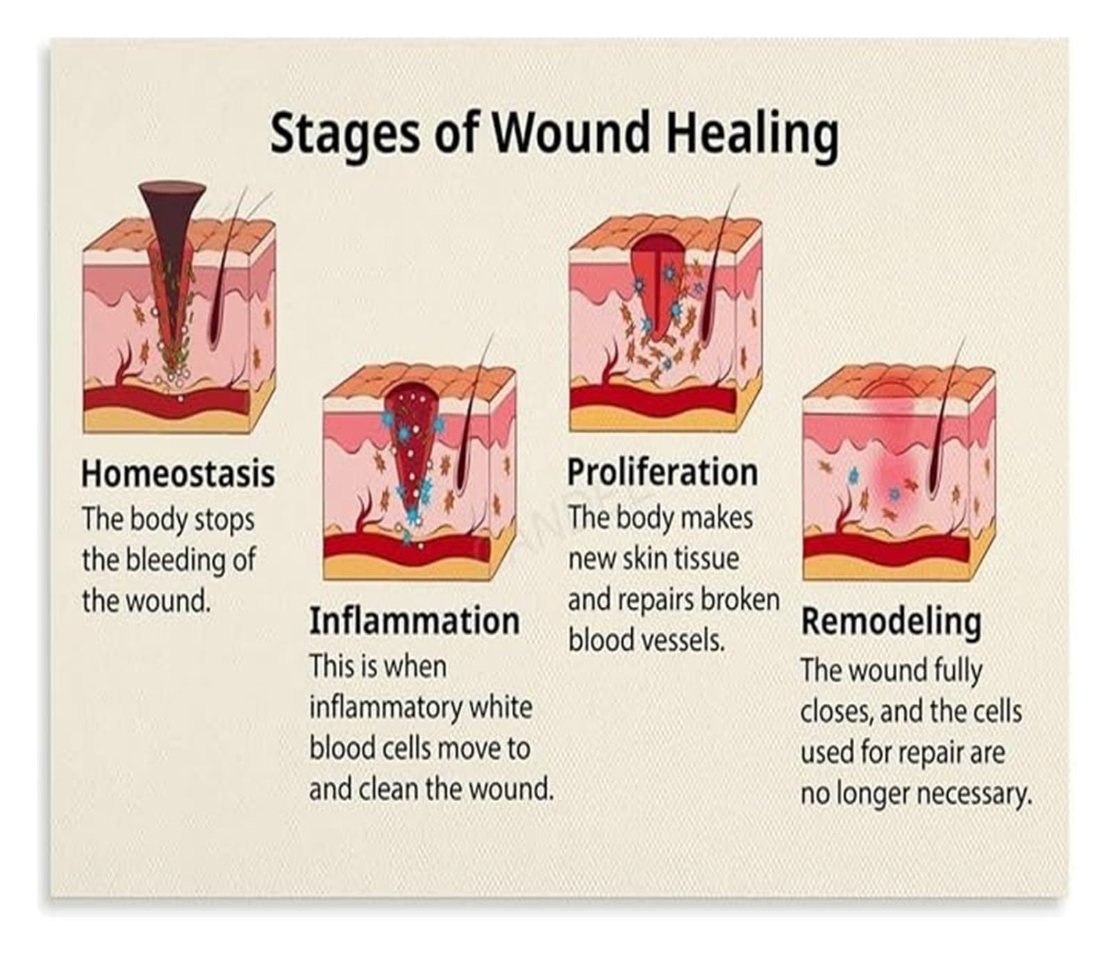 IDGTTLDF Wound Staging Guide Poster Decubitus Ulcer Grades Nurse Study Living Room Wall Print